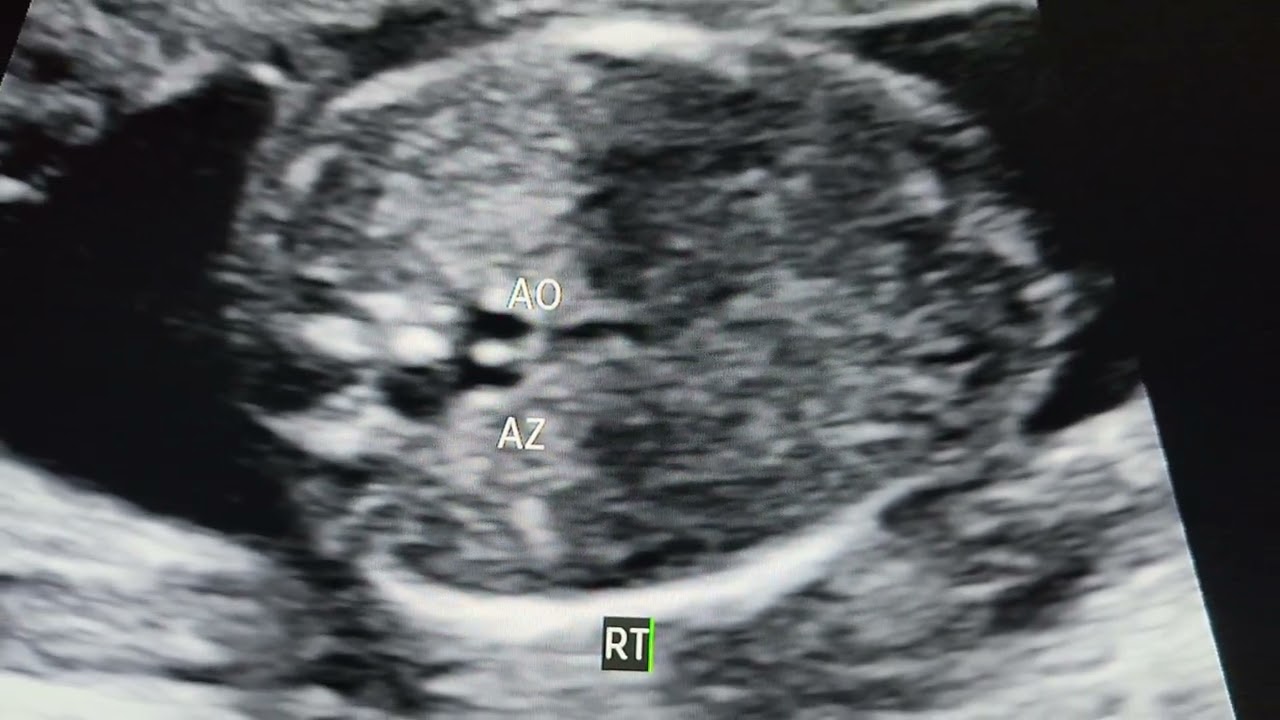 FETAL ECHO  TEACHING-RIGHT STOMACH,RIGHT LIVER,INTERRUPTED IVC REFER SERIES.DR S PRADEEP.