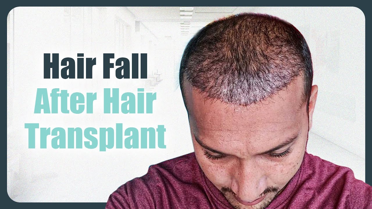 Why Does 'HAIR SHED' After Transplant? 🤔 | Hair Shedding Phase Explained | New Roots