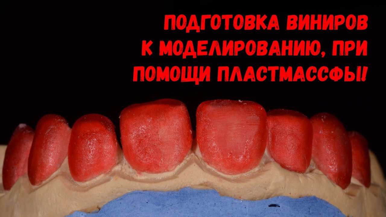 Как изготавливают виниры? Подготавливаем основу для моделирования виниров.