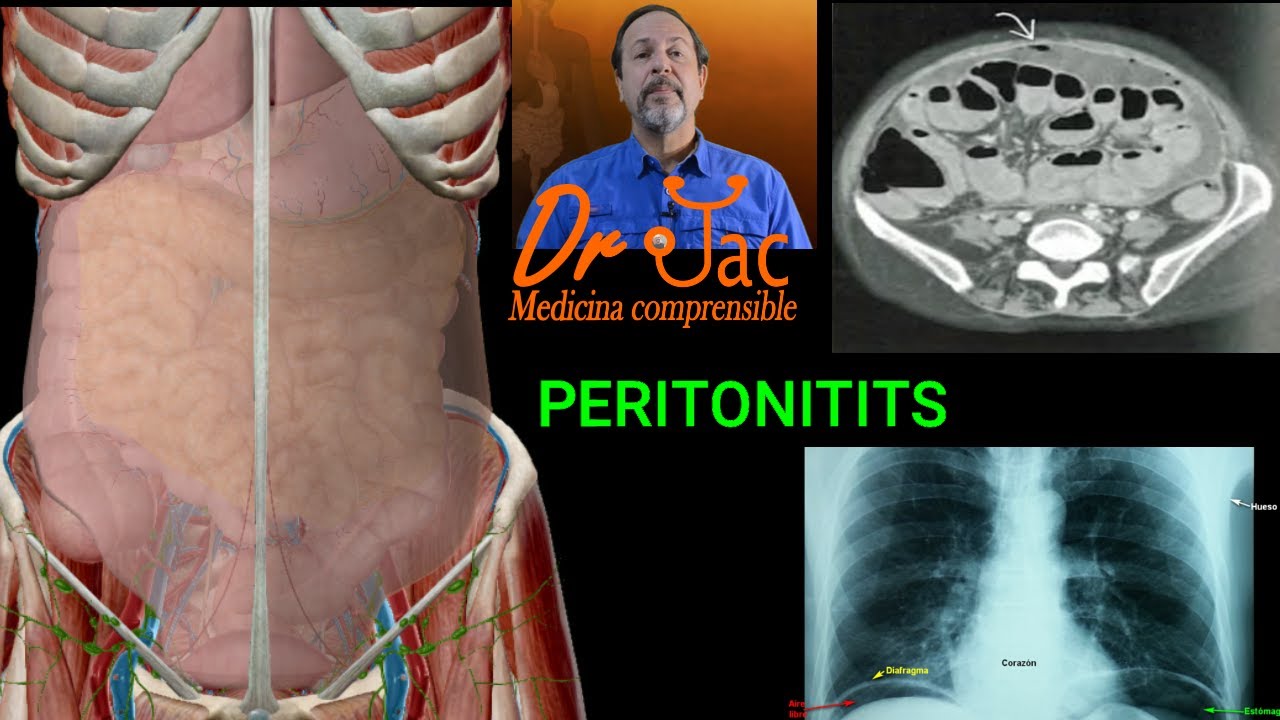 Peritonitis