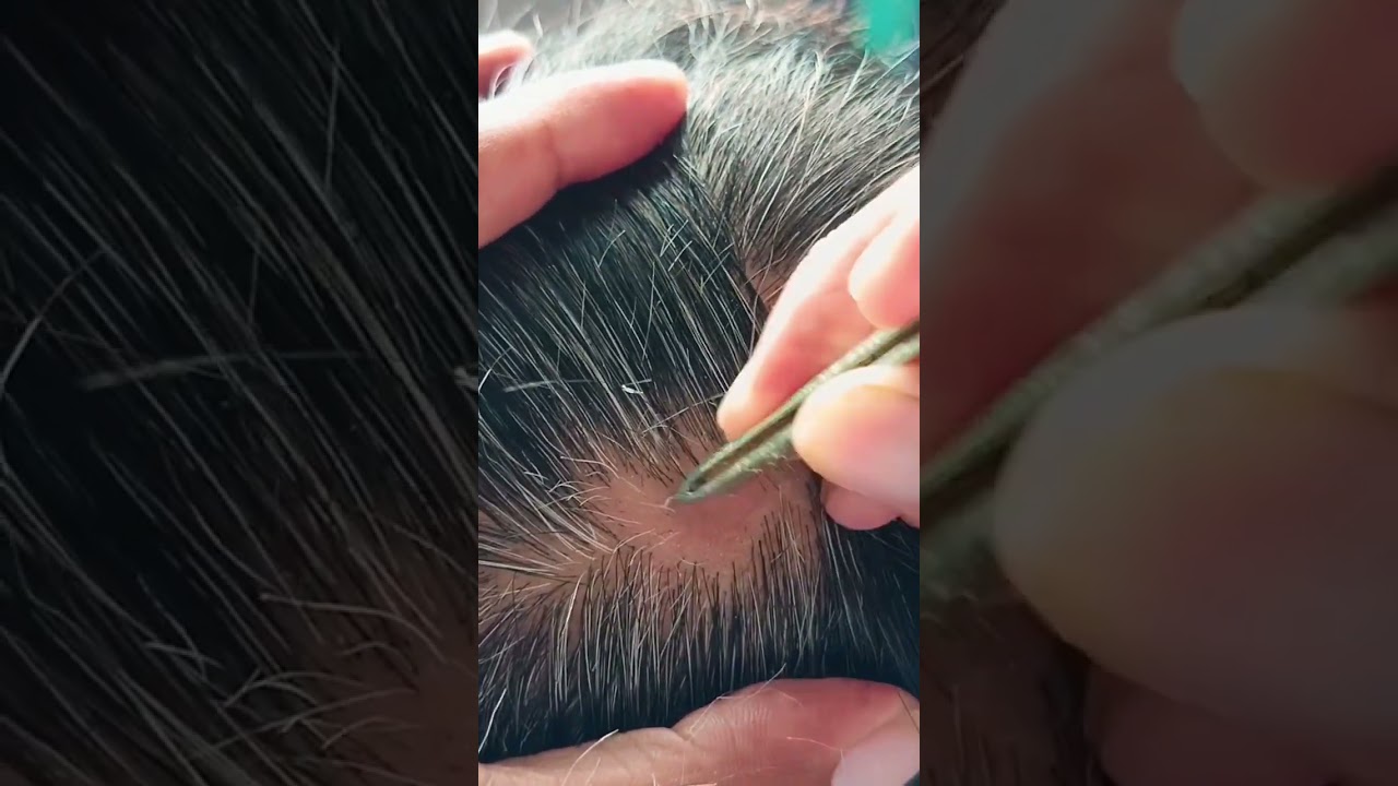 Most satisfying white hair removal#59#satisfying#stressreliefmusic