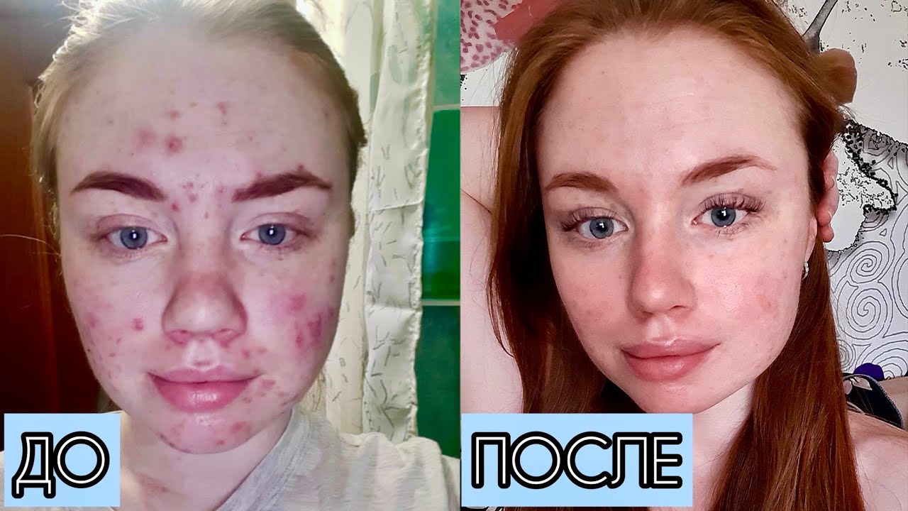 Сотрет / Ретиноиды / Лечение акне до после