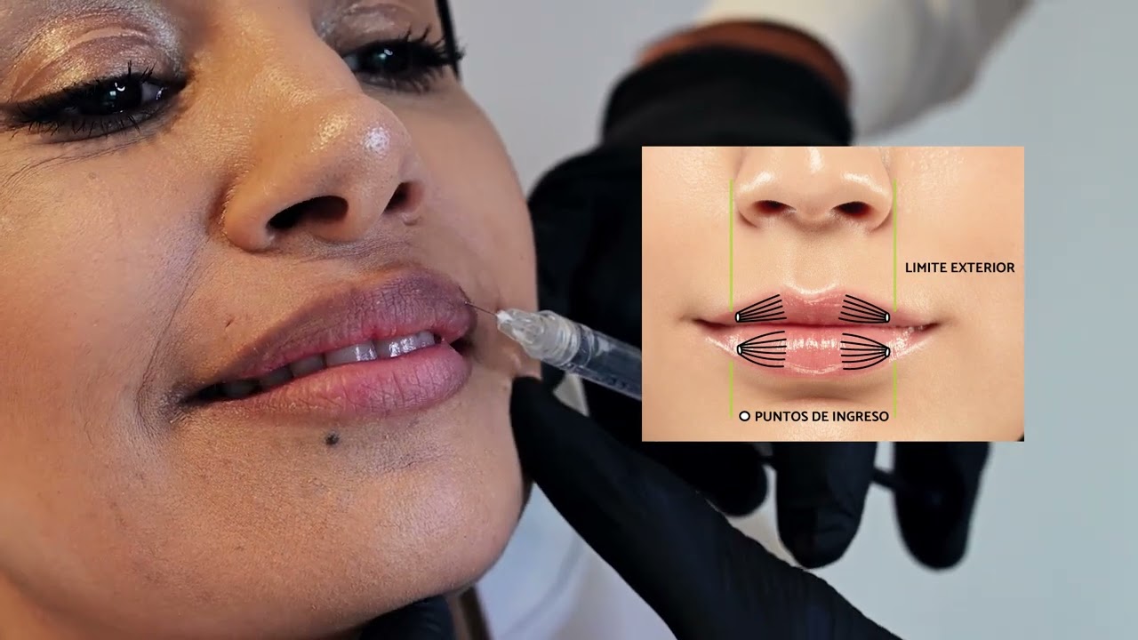 Tutorial Relleno de labios con técnica mixta VMC