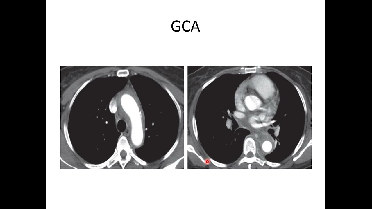 Imaging spectrum of aortitis