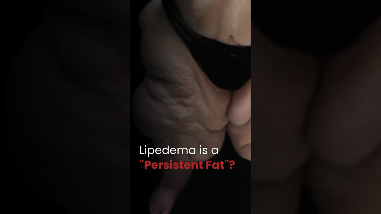 What makes lipedema fat a persistent fat?