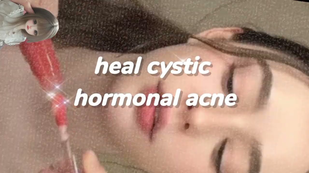 Heal cystic & hormonal acne 