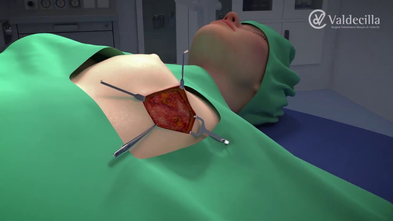 Valdecilla comienza a aplicar la Radioterapia Intraoperatoria