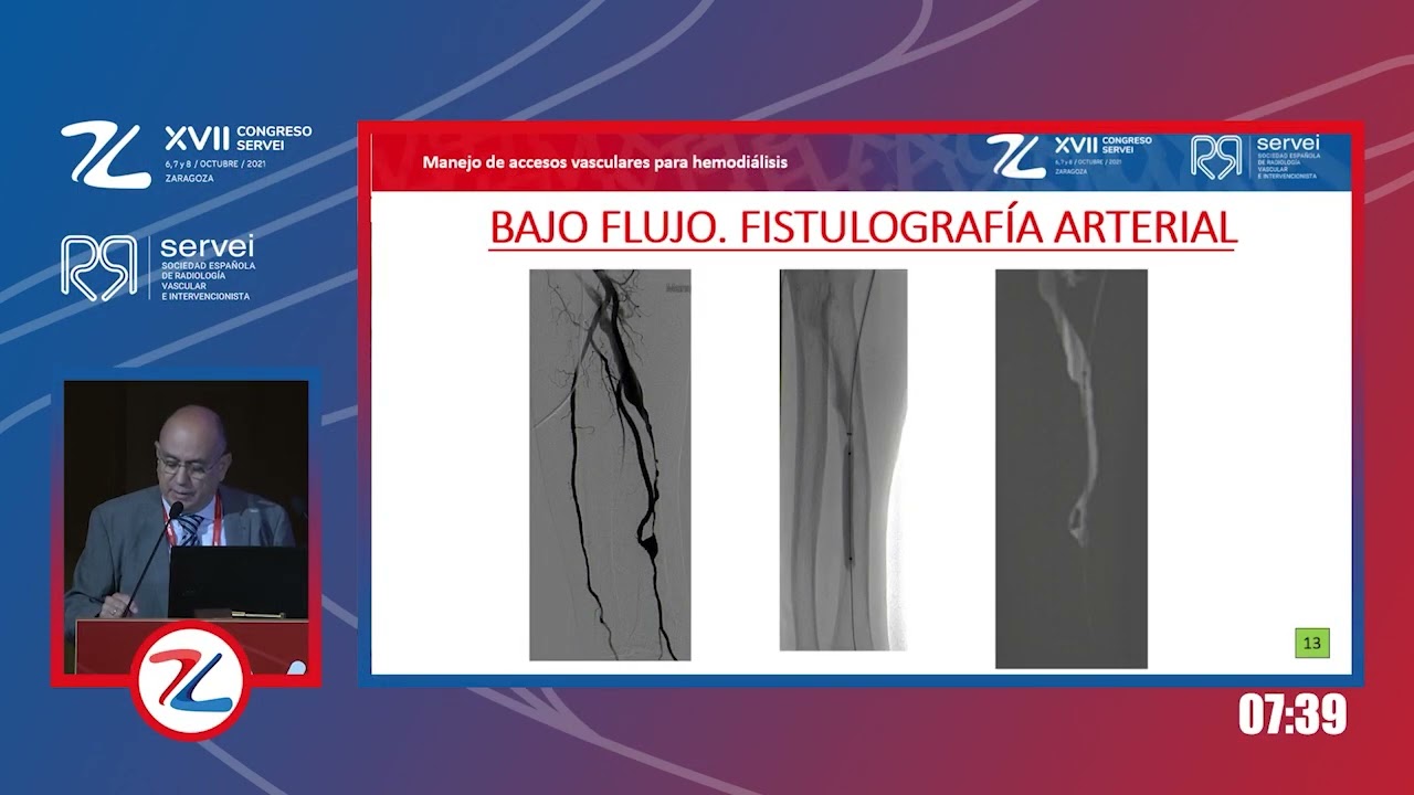 Manejo de accesos vasculares para hemodiálisis - Dr. José García-Medina | Congreso SERVEI 2021