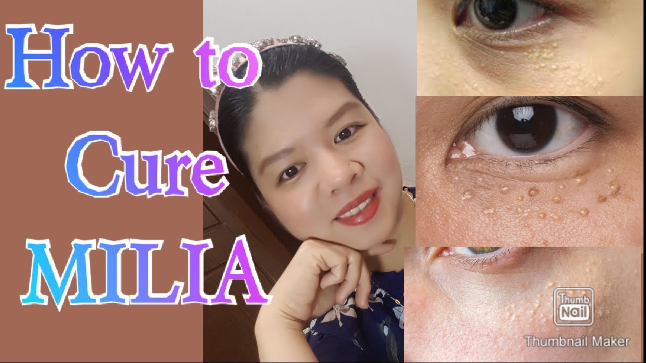 How to cure MILIA at home secret remedy