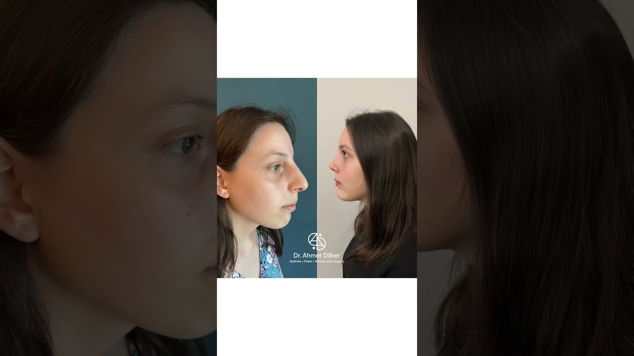 COMBINED RHINOPLASTY + CHIN IMPLANT + FAT INJECTION 🌟 Dr. Ahmet Dilber 💫 