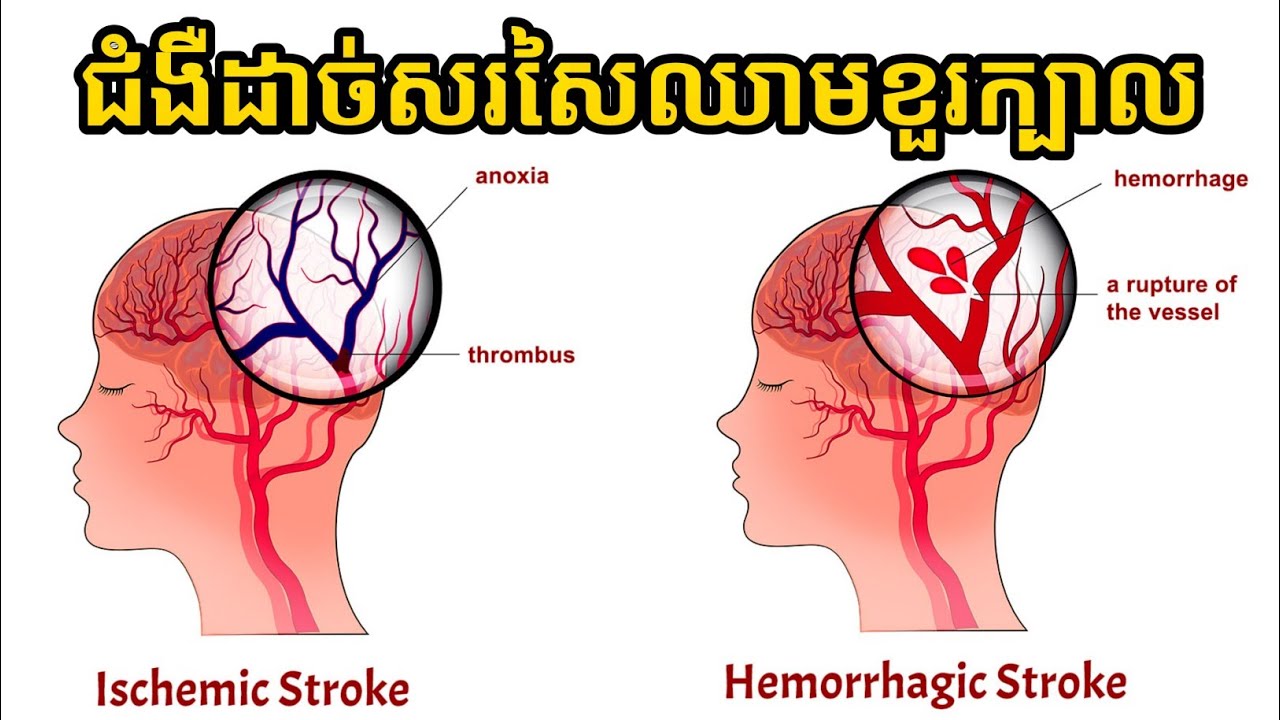 ជំងឺដាច់សរសៃឈាមខួរក្បាល | ចំណេះដឹងសុខភាព | success knowledge