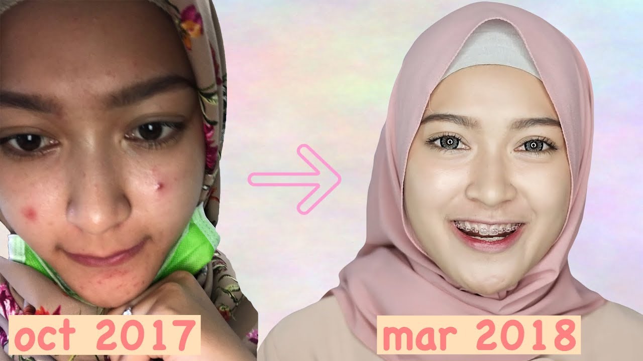 SKINCARE ROUTINE UNTUK MUKA BERJERAWAT | saritiw