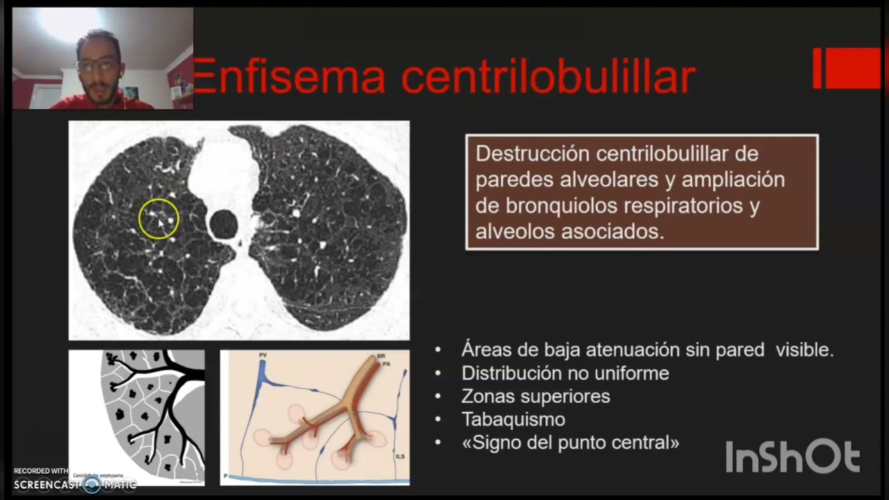 Huecos Pulmonares