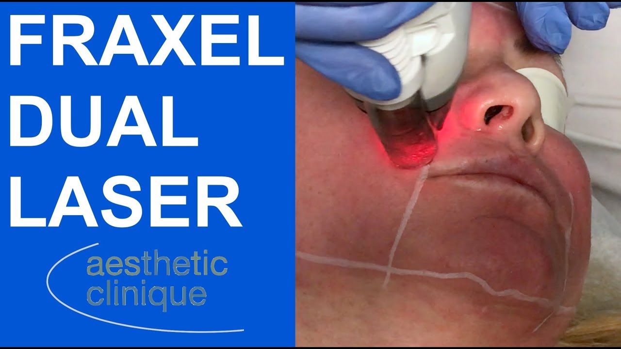 Fraxel Dual Laser - Non-Ablative Laser Resurfacing for Pigment and Precancers