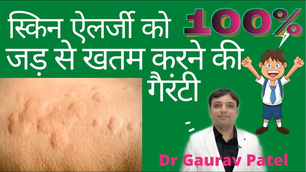 Skin allergy ko 100% khatam karne ki treatment at home|How to cure skin #allergy with 100% guarantee