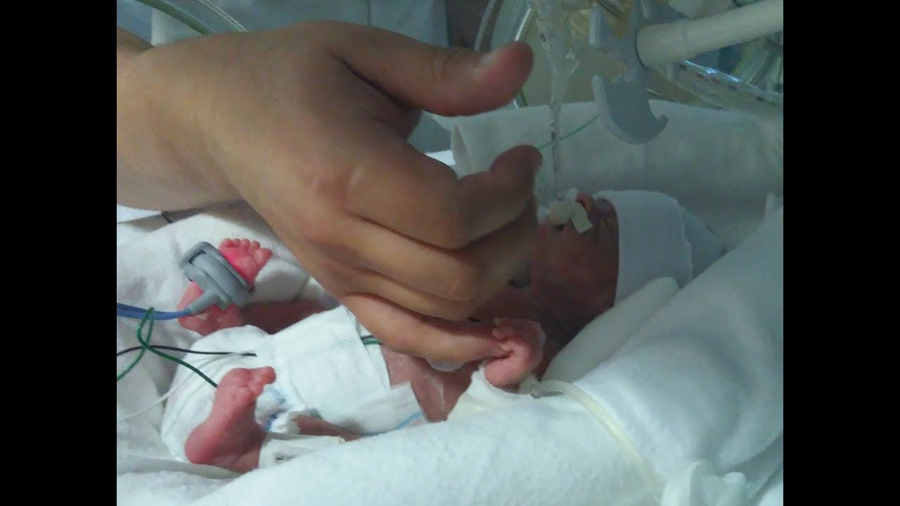 BEBE PREMATURO EXTREMO - MEDICINA EXTRAORDINARIA