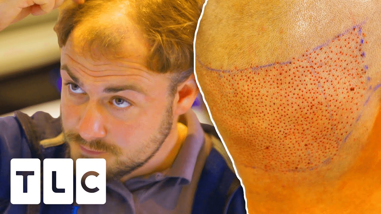 Builder Stops Baldness Banter With Hair Transplant | The Hair Loss Clinic