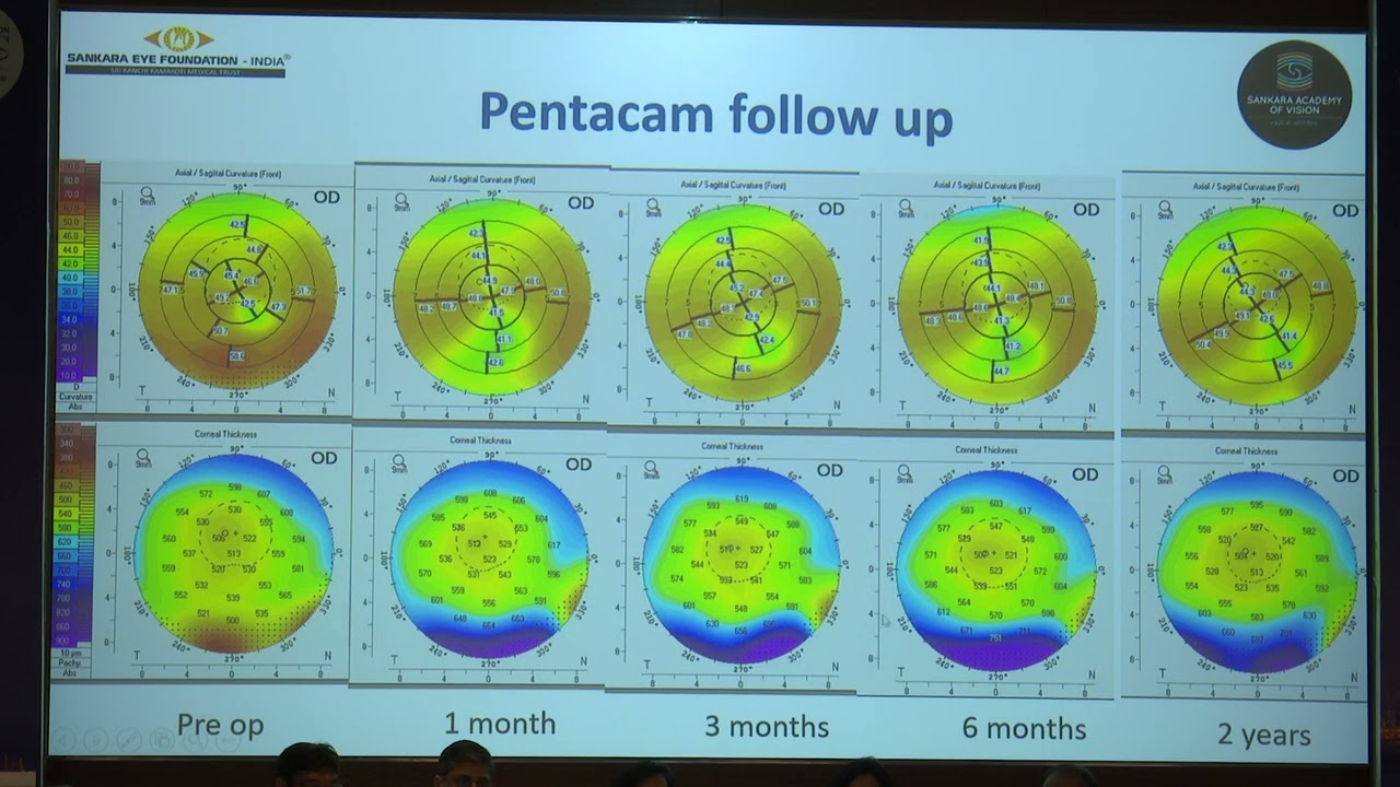 AIOC2022 FP1225 Cornea I topic Corneal inlay for pellucid marginal degeneration