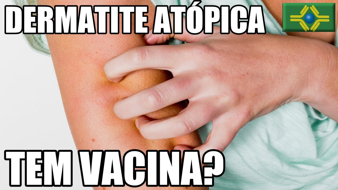 DERMATITE ATÓPICA | Existe VACINA? | Quais os TIPOS DE DERMATITE ATÓPICA?