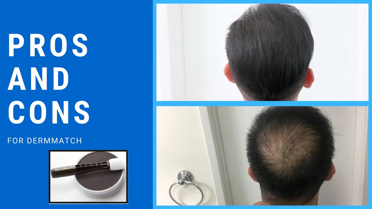 Pros and Cons To Using DermMatch