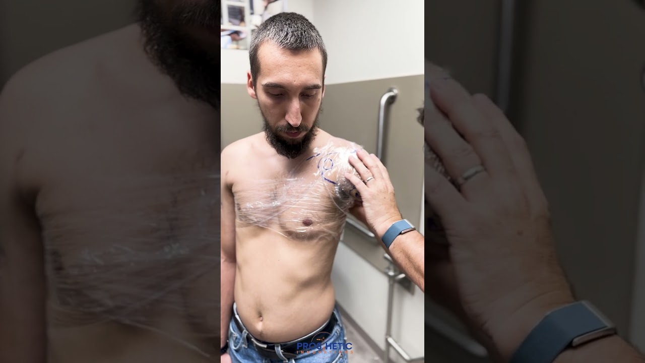 Short Trans-Humeral Prosthetic Casting | Revived Soldiers Ukraine | Prosthetic Innovations