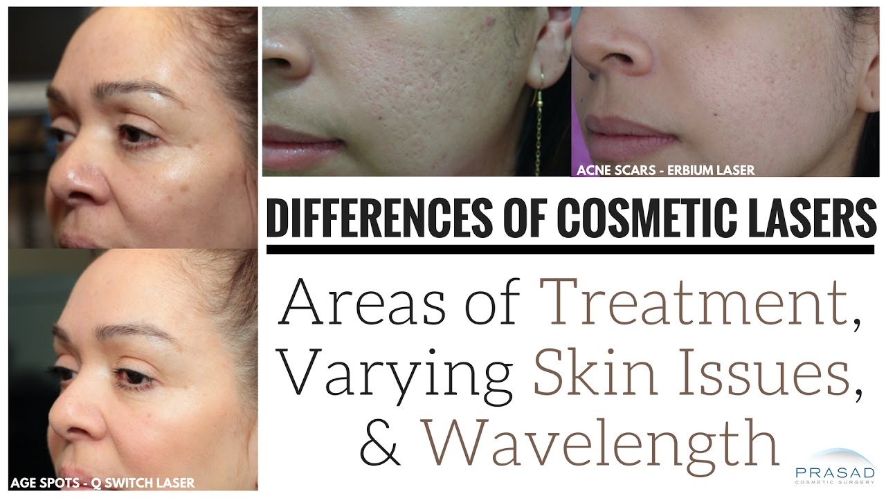 Differences of Types of Lasers Used for Skincare and Skin Issues