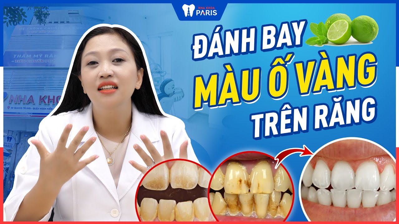 Răng ố vàng: Nguyên nhân và cách điều trị hiệu quả | nha khoa Paris