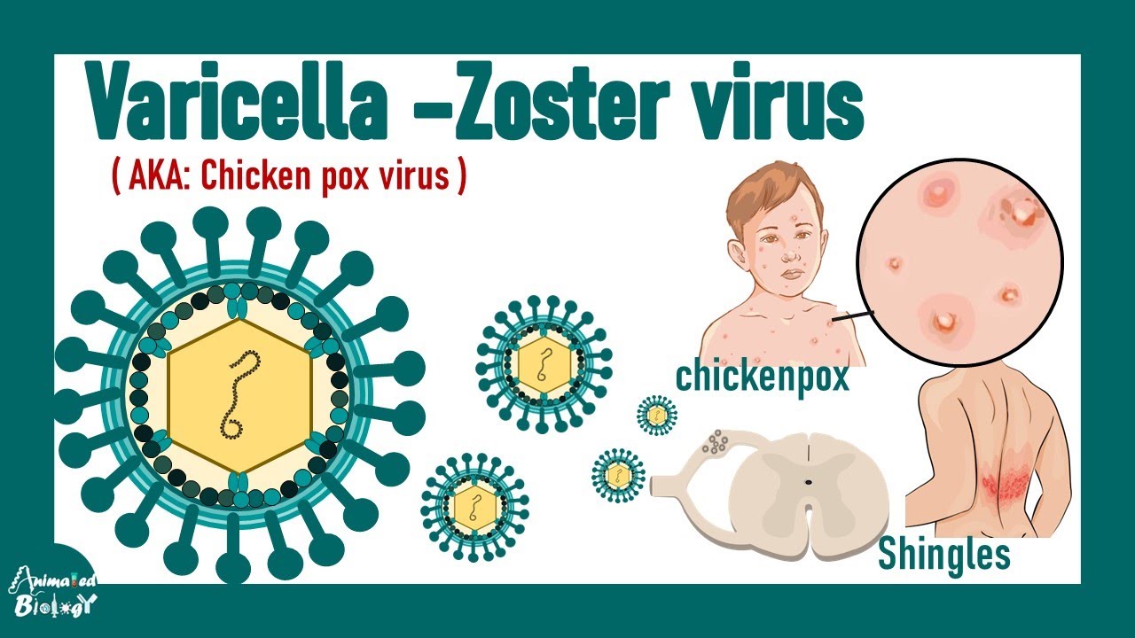 Вирус Varicella Zoster | Ветряная оспа и опоясывающий лишай | Патология, диагностика и лечение