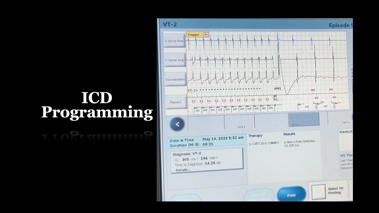 Merlin PCS Demo - ICD Programming | Part 4