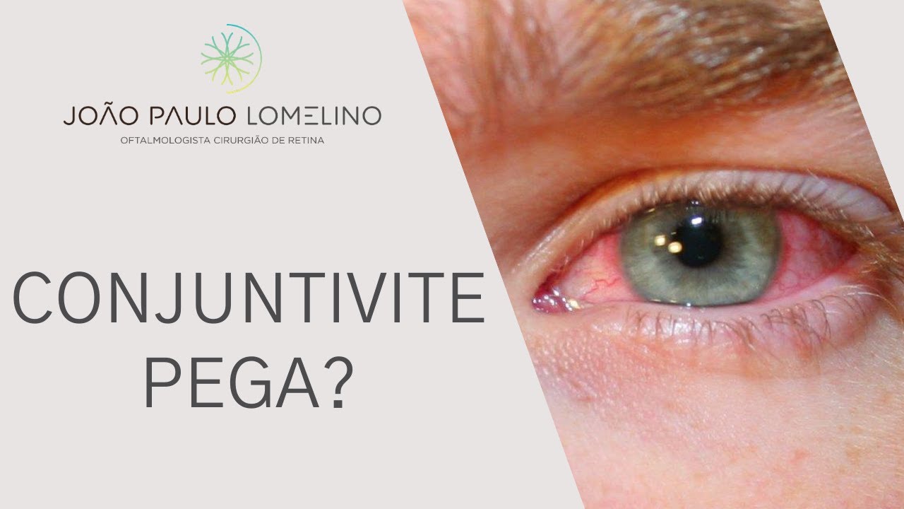Conjuntivite pega? | Dr. Jo&atilde;o Paulo Lomelino
