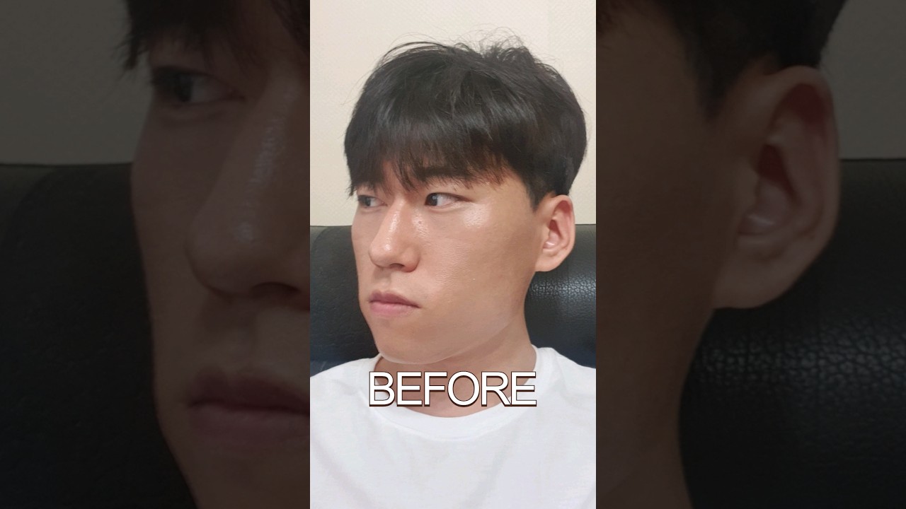 Double Jaw Surgery Transformation!
