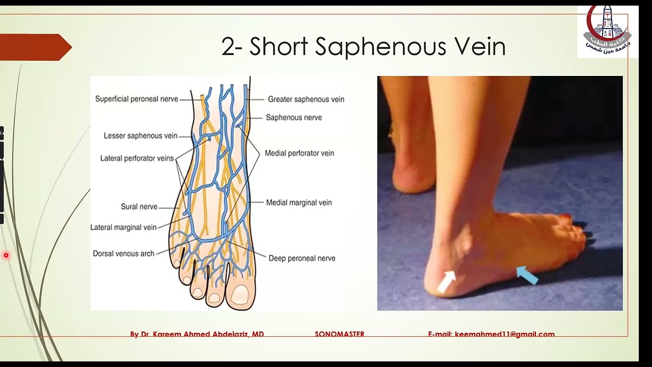 Varicose Doppler Anatomy & Pathophysiology by Dr.Kareem A.Abdelaziz..part (2/2)