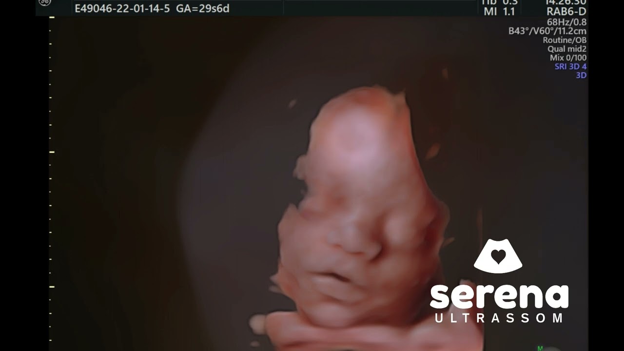 Olha essa Fofura de 29 Semanas no 5D