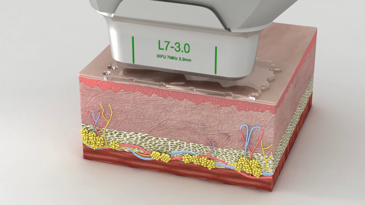 ULTRAFORMER SCIENCE OF HIFU