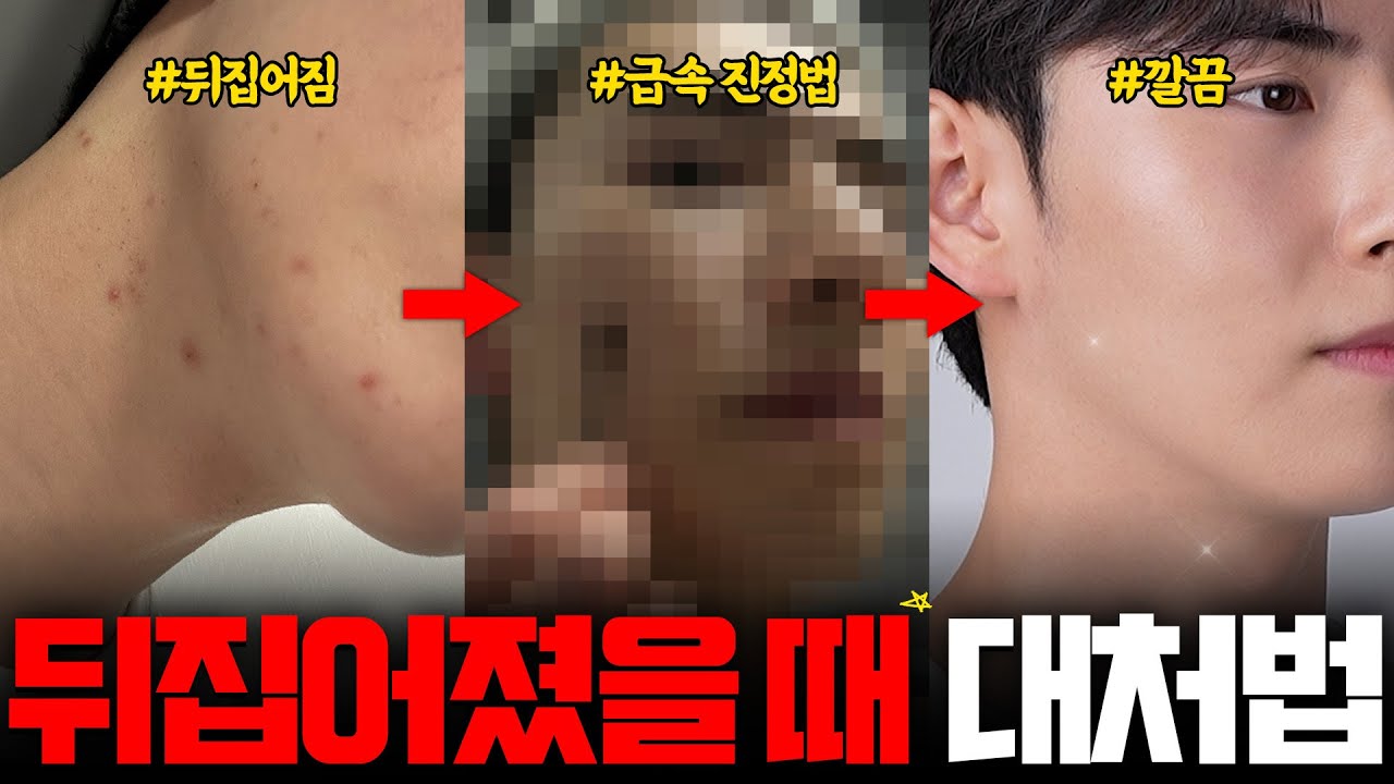 가장 효과 봤던 뒤집어진 피부 되돌리는 방법🔥🔥