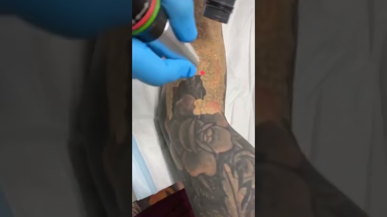 SUSLASER Picolaser Tattoo Removal Whole Arm Tattoo Removal With Less Chance Of Forming Bubbles