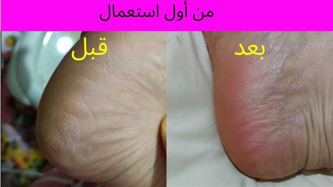 روتين العناية بالقدمين #ترطيب_تقشير الوصفة لتهنيك من تشقق وتفلاح 😍😍/Ghizlane Bio