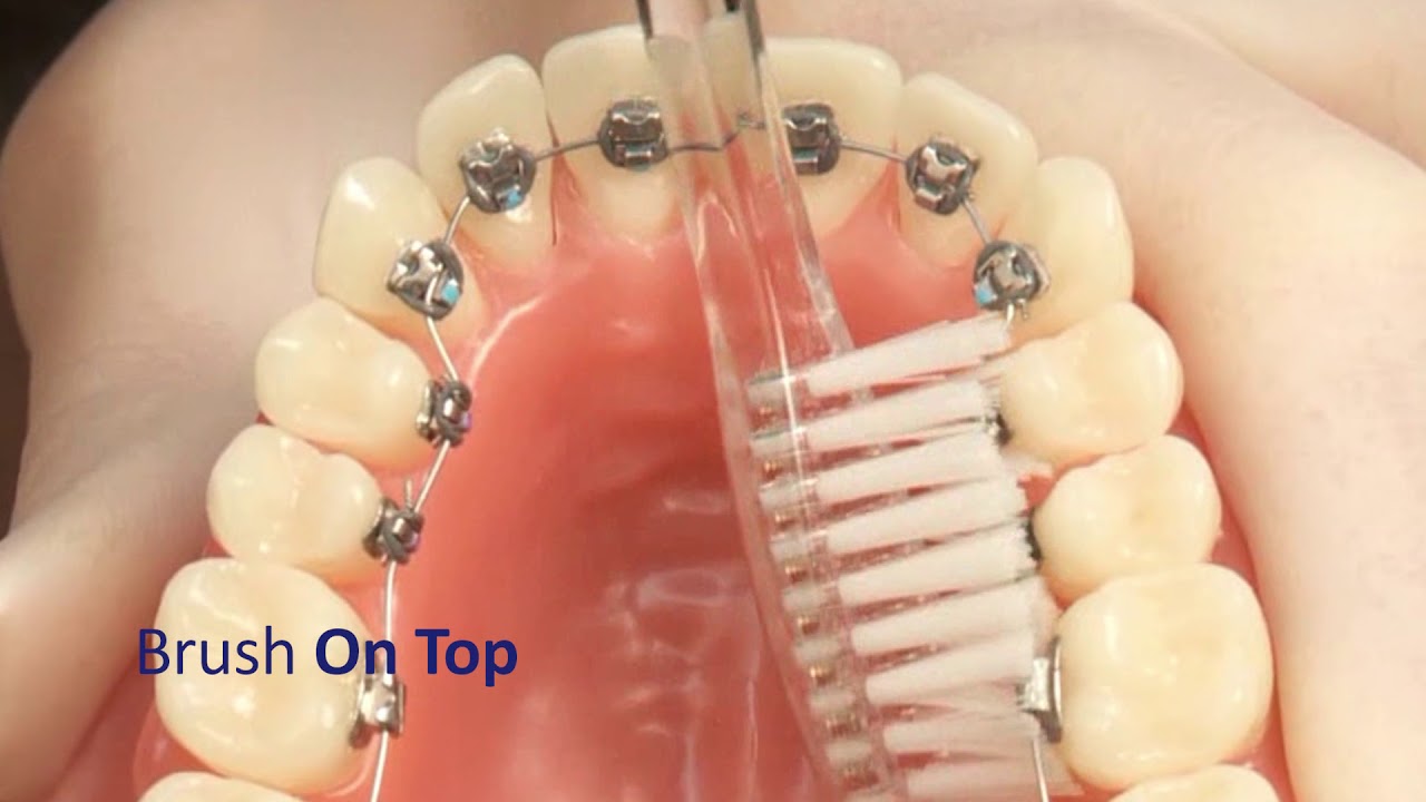 Lingual Homecare Instructions at Hidden Braces Boutique