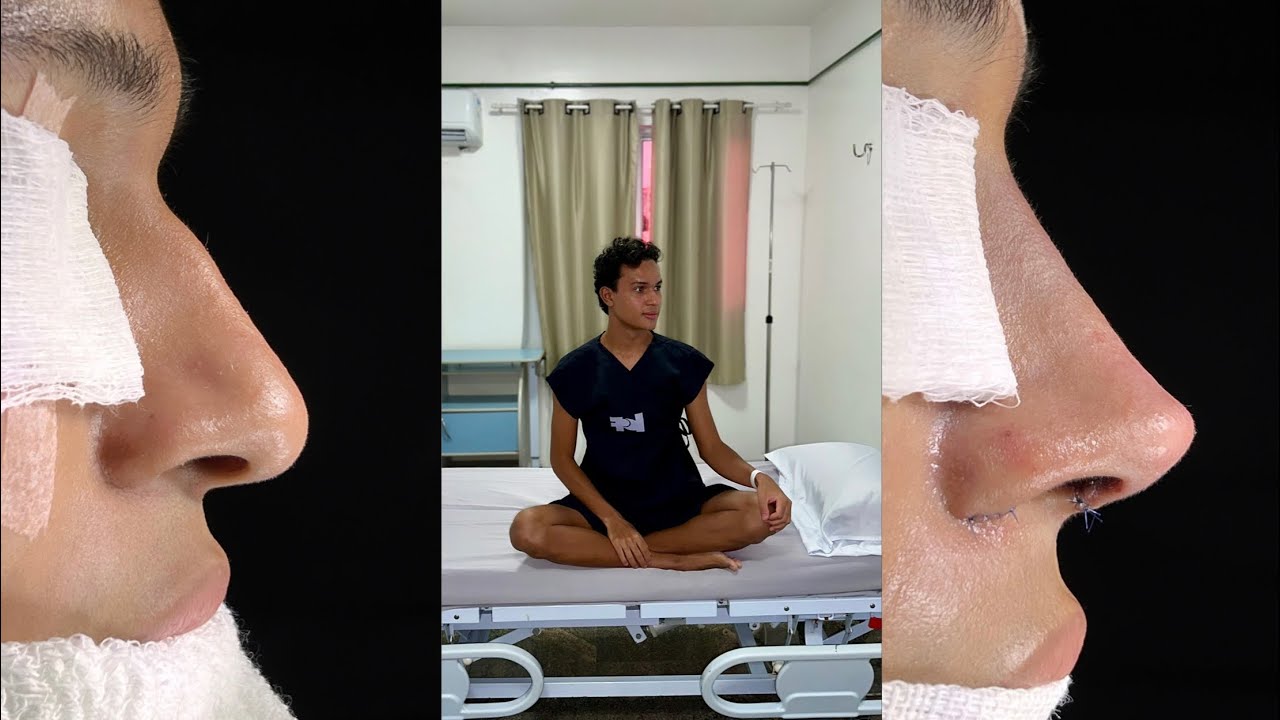 Fiz minha rinoplastia dos sonhos: todo o processo REAL! 👃🏽🏥🥹
