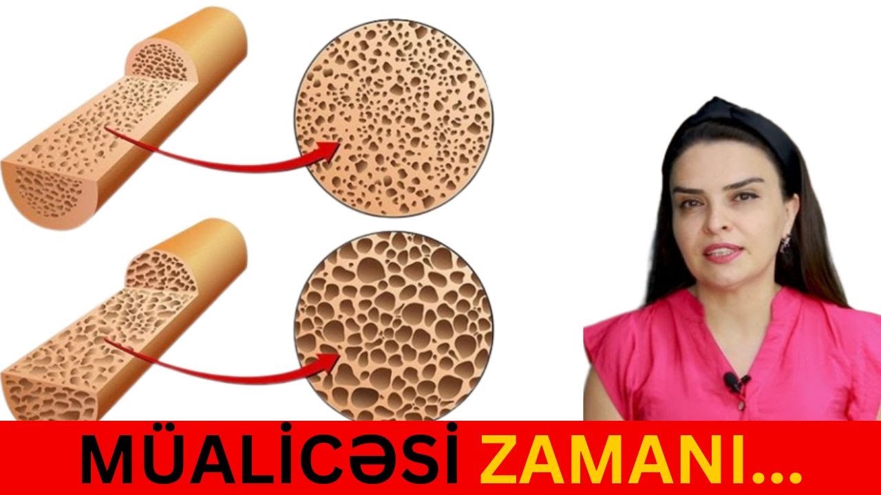 Sümük Əriməsi - Vaxtında Müalicə Olunun, YOXSA...