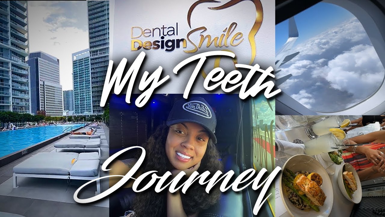 I GOT VENEERS IN MIAMI 🦷💰MY EXPERIENCE + VLOG | NO DAMAGE TO REAL TEETH?