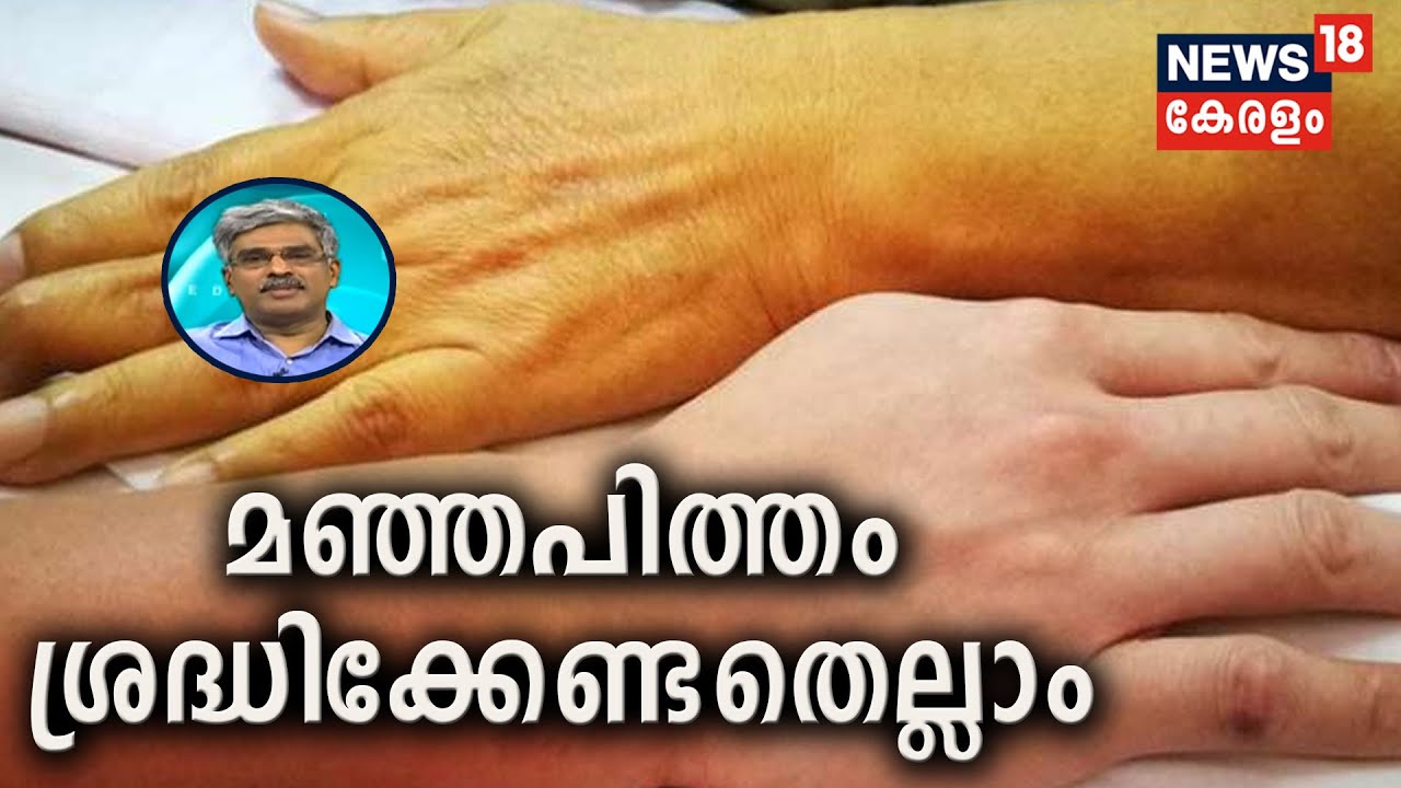Dr. Q: മഞ്ഞപിത്തം ശ്രദ്ധിക്കേണ്ടതെല്ലാം | Jaundice | 21st April 2020