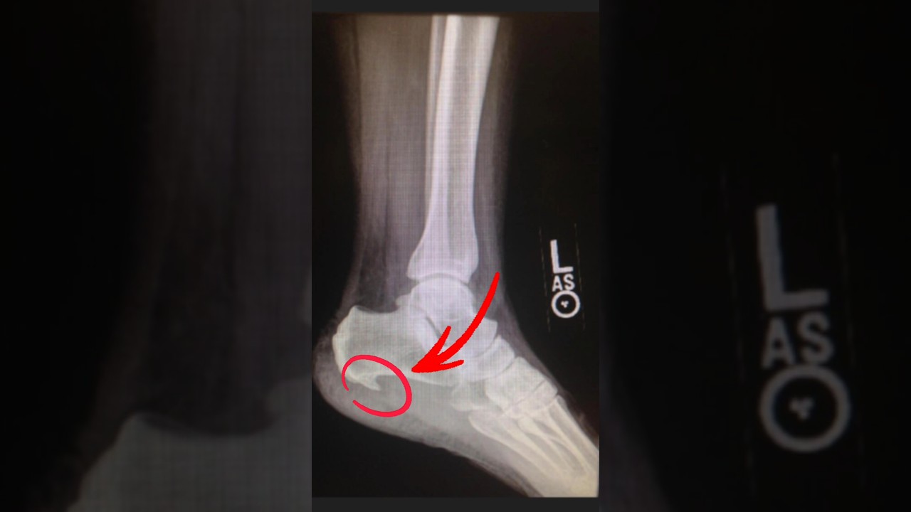 Heel Pain Mystery Solved! 😱 Is It a Heel Spur? #Shorts