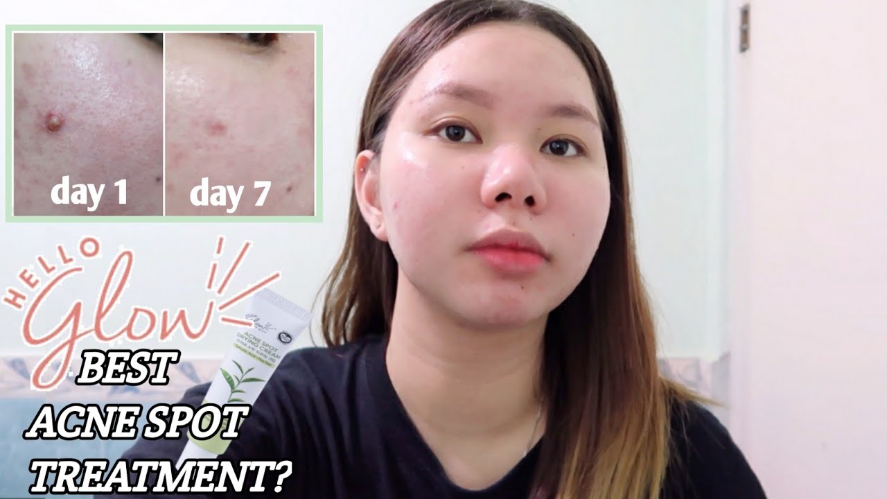 HELLO GLOW ACNE DEFENSE SET REVIEW │ BEST Acne Spot Treatment?