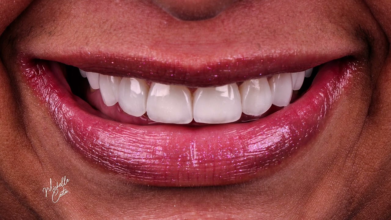 Facetas em Resina: Veja Esse Antes e Depois Surpreendente
