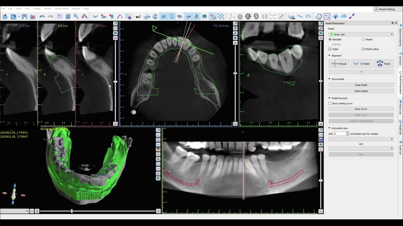Blue Sky Bio, CBCT implant planning, (Part 3), Registeration of CBCT + Model, Dr Khaled Ekram