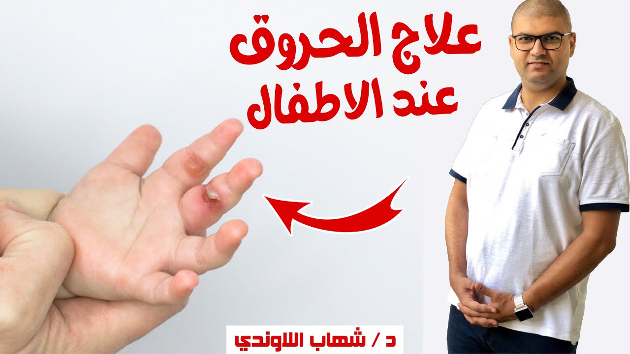 الحروق عند الاطفال وعلاجها - علاج حروق الاطفال