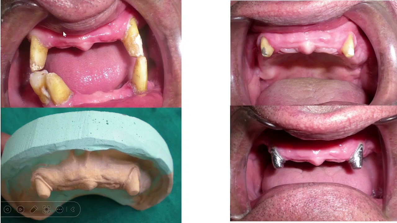 Telescopic Denture. Dr Mohamad Sarraj