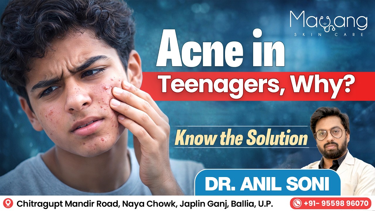 Why Teenagers Get Acne & How to Treat It Properly | Dr. Anil Soni | Ballia