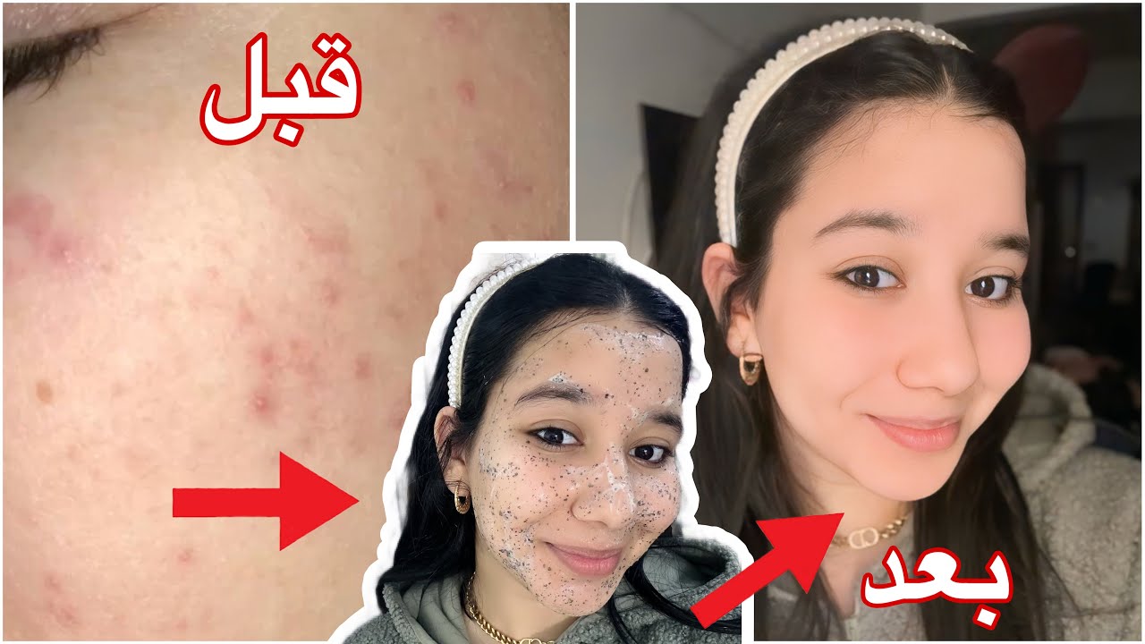 التخلص من الحبوب في اقل من 3 ايام🤩🎀 أقوي ماسك للحبوب وأثار الحبوب والتصبغات🎀 | تجهيزات العيد🎀